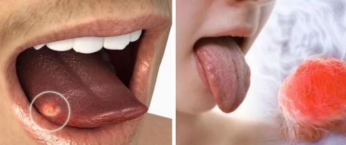 Предупреждение о раке языка: Названы семь неочевидных симптомов у курильщиков - «Новости»