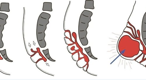 Лечение эпителиального копчикового хода
